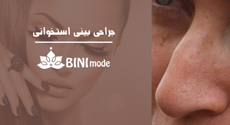 جراحی بینی استخوانی