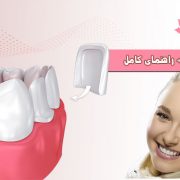 کامپوزیت دندان در کرج