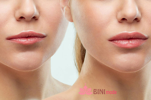 تزریق چربی به لب در کرج