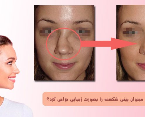 جراحی زیبایی بینی شکسته