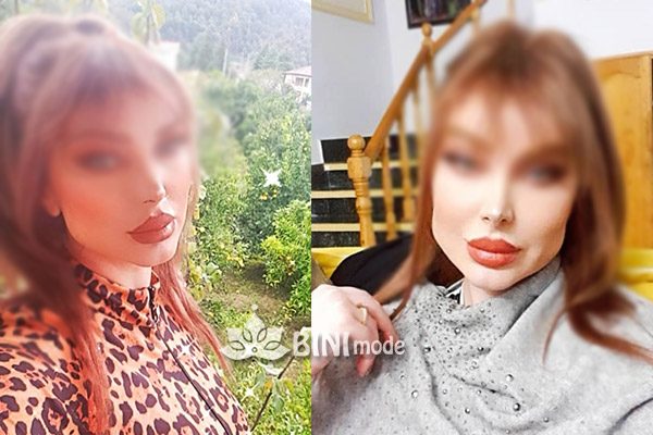 عکس ارسالی مشتری زاویه سازی فک عکس ارسالی مشتری زاویه سازی فک