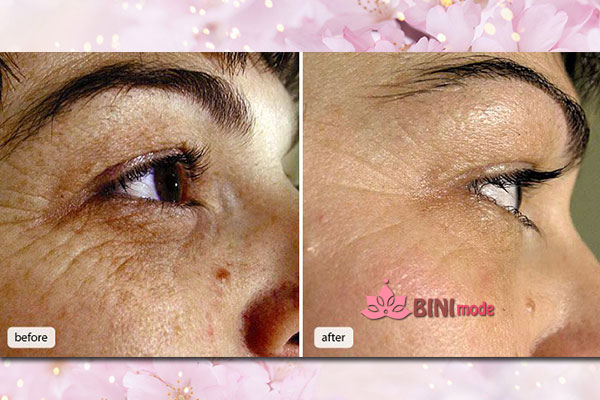 مزوتراپی صورت