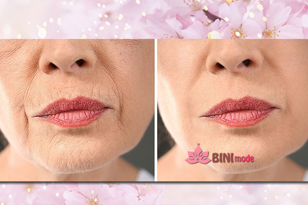 مزوتراپی قبل و بعد