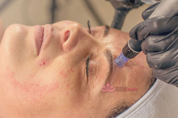 مزوتراپی چیست؟