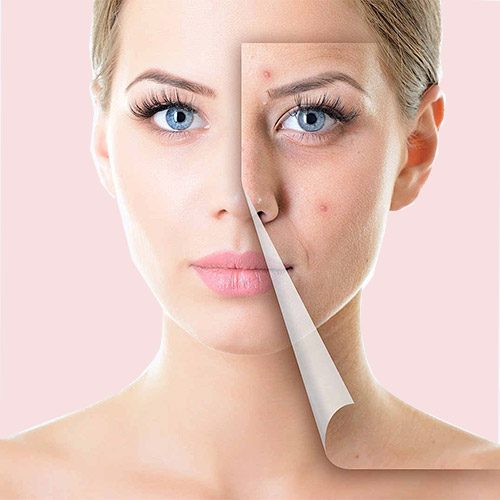 میکرونیدلینگ چیست؟