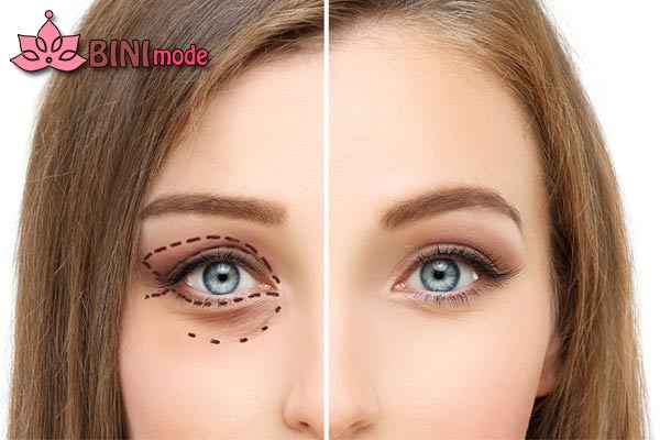جراحی پلک به چه صورت است؟