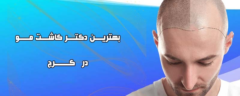 کاشت مو در کرج