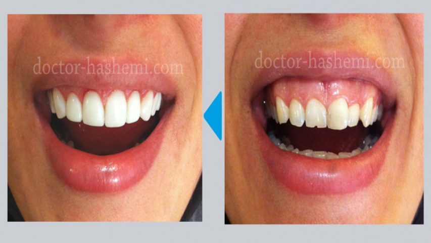 قبل و بعد از انجام کامپوزیت دندان ۶
