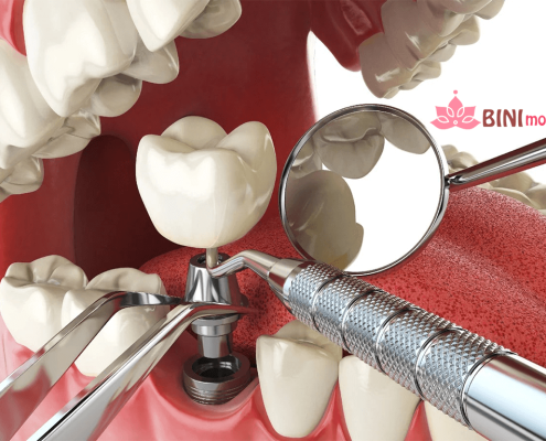 ایمپلنت چیست؟