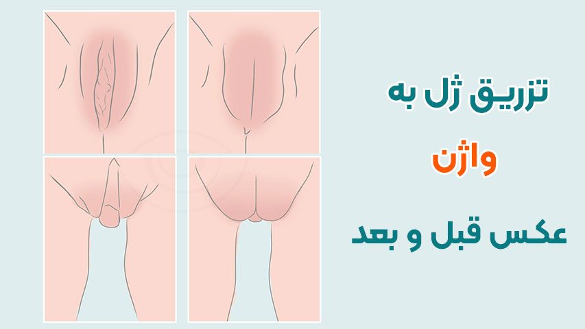 تزریق ژل به واژن قبل و بعد