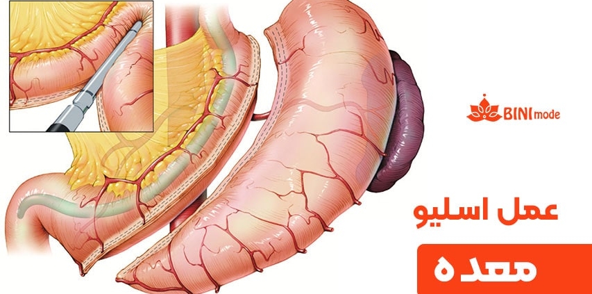 عمل اسلیو معده