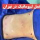 لیپوماتیک در تهران