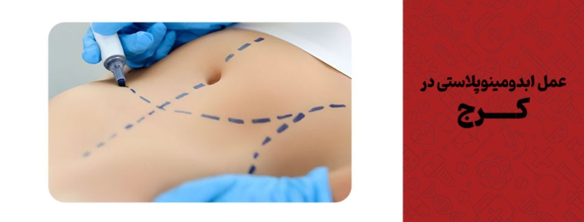 عمل ابدومینوپلاستی در کرج