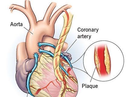 بای پس معده