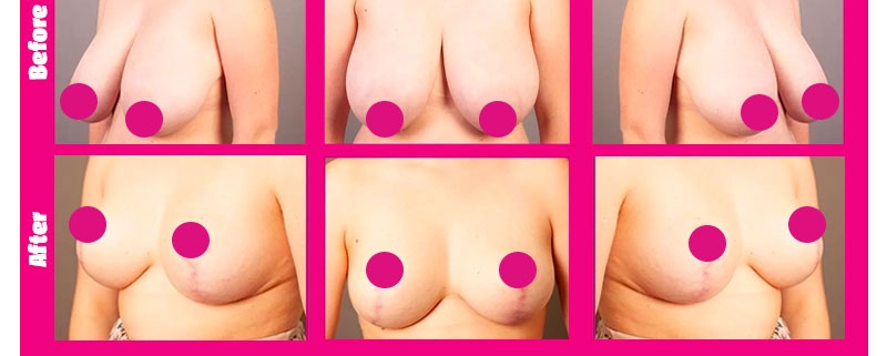 ماموپلاستی در کرج