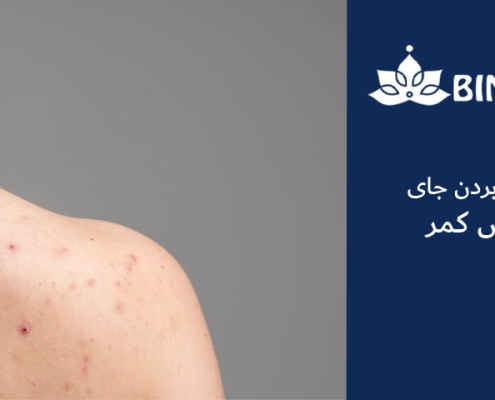 از بین بردن جای جوش کمر