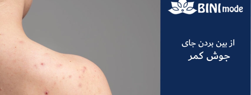 از بین بردن جای جوش کمر