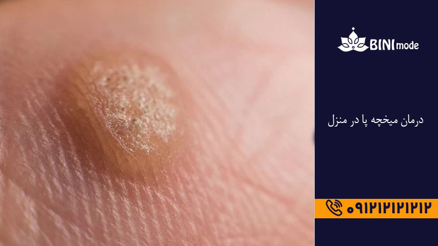 درمان میخچه پا