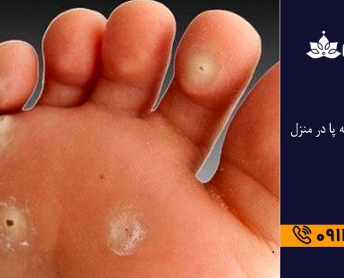 درمان میخچه پا در منزل