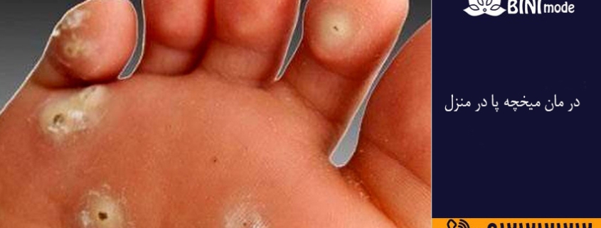 درمان میخچه پا در منزل