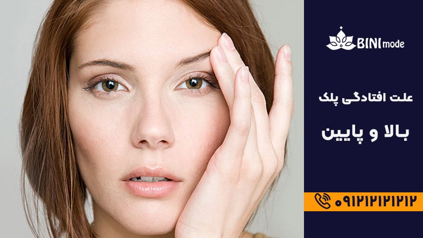 علت افتادگی پلک بالا