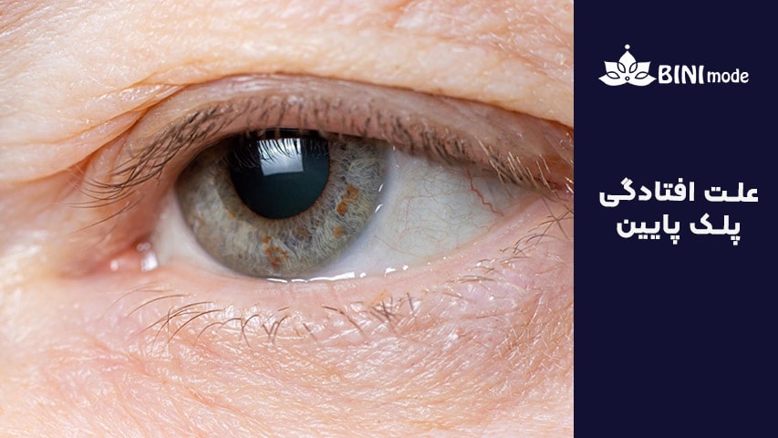علت افتادگی پلک پایین