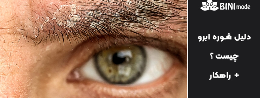 دلیل شوره ابرو