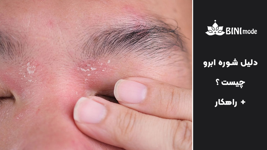 علت شوره ابرو
