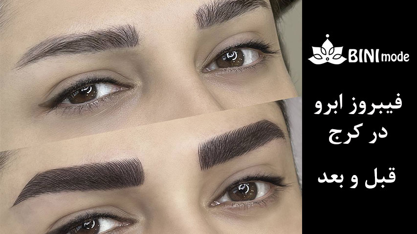 عکس قبل و بعد فیبروز ابرو