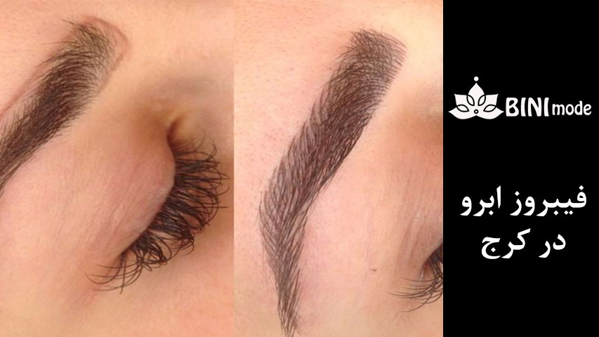 قبل و بعد از فیبروز 4