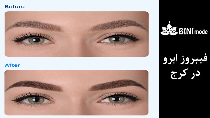 قبل و بعد فیبروز ابرو12