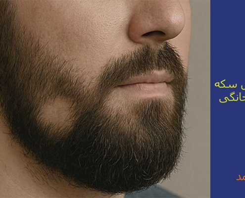 ریزش ریش سکه ای