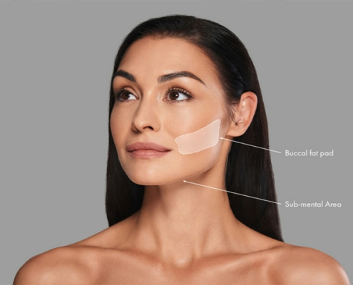 مراقبت بوکال فت