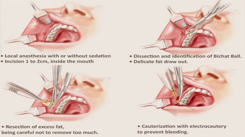 جراحی-بوکال-فت-۳