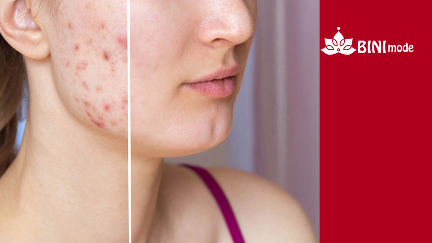 کاهش-رد-جوش-و-آکنه