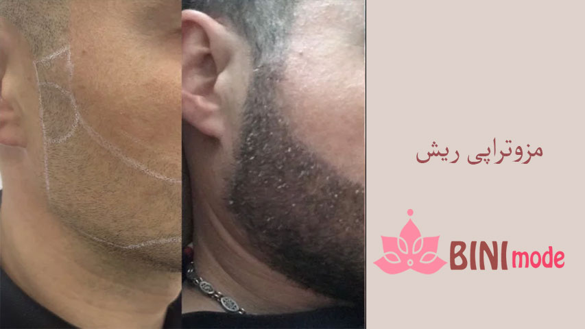 مزوتراپی ریش