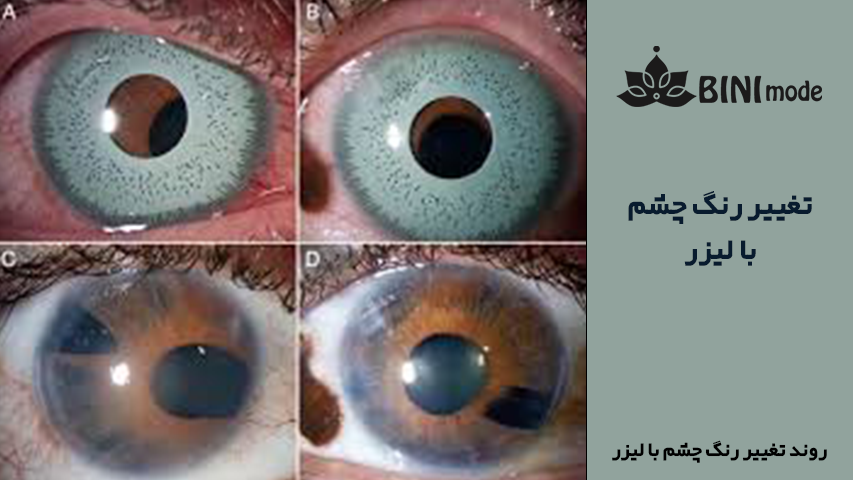 لیزر تغییر رنگ چشم با لیزر