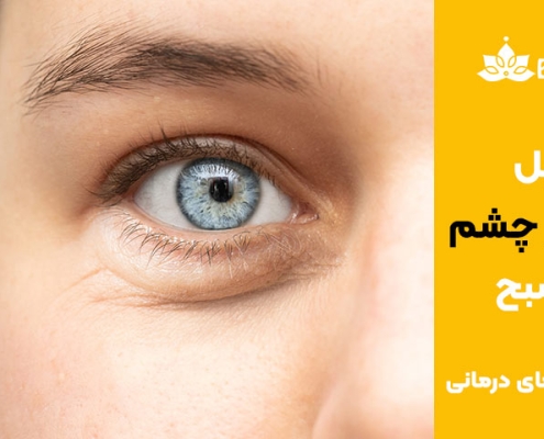 دلیل پف زیر چشم در صبح